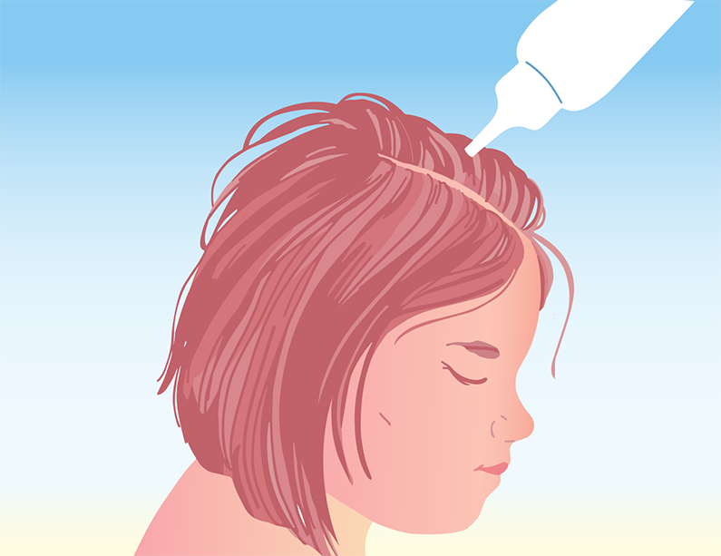 Piirroskuva, jossa tytön hiuksiin levitetään täishampoota valkoisella pullolla